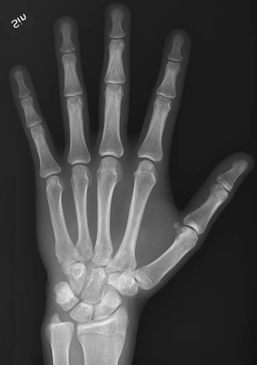 Radiografía de una mano